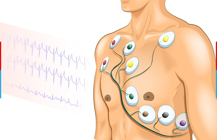 ECG